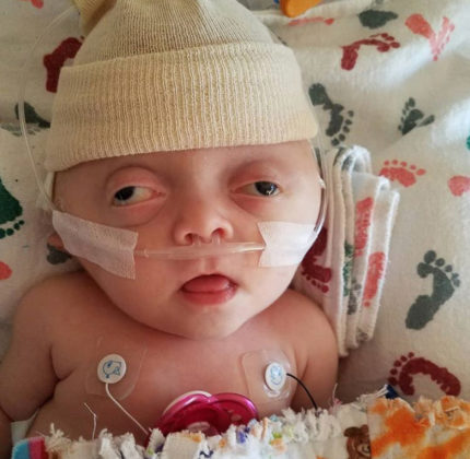 Our Daughter Had Her Skull Removed At Just Five Weeks Old – She Is Brave, Beautiful And We Couldn’t Love Her More - Amber Thibault 2 430x420